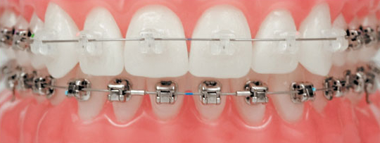 Damon braces